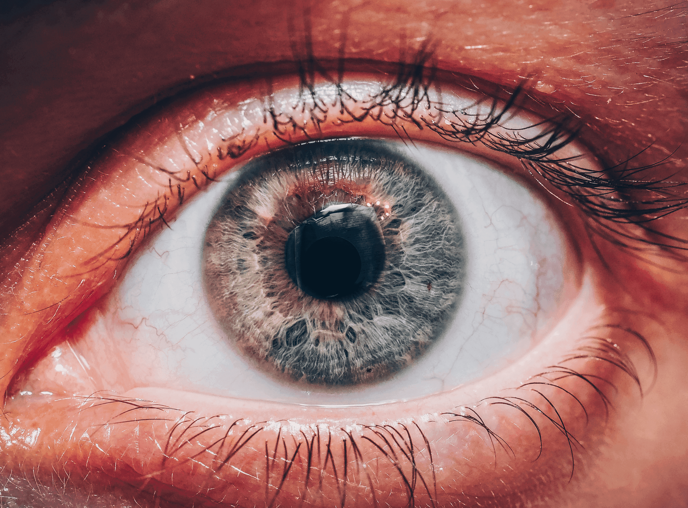 visual snow syndrome eye.png